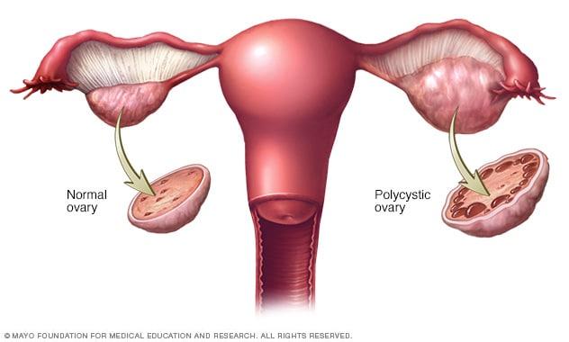 understanding PCOS and Its Impact on Weight‌ Management
